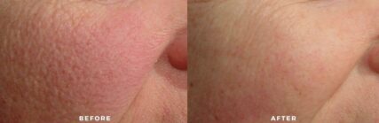 laser genesis facial before and after shilohmedical 3