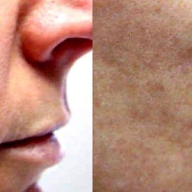 laser genesis facial before and after shilohmedical 5