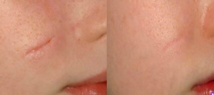scar removal