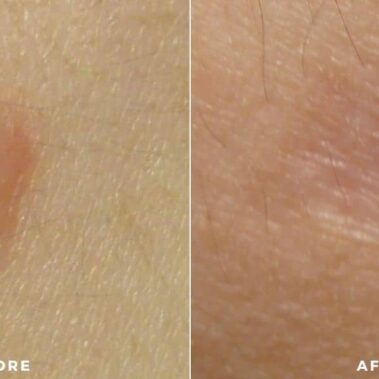 scar treatment before and after shiloh medical 1