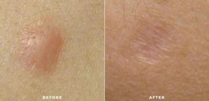 scar treatment before and after shiloh medical 1