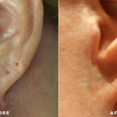 scar treatment before and after shiloh medical 2