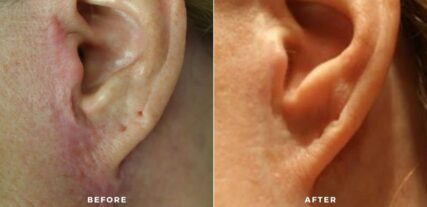 scar treatment before and after shiloh medical 2
