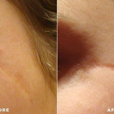 scar treatment before and after shiloh medical 3