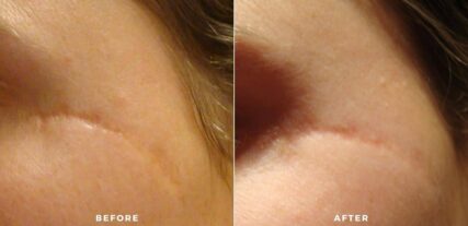 scar treatment before and after shiloh medical 3