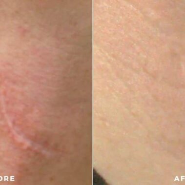 scar treatment before and after shiloh medical 4