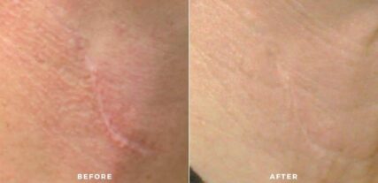 scar treatment before and after shiloh medical 4