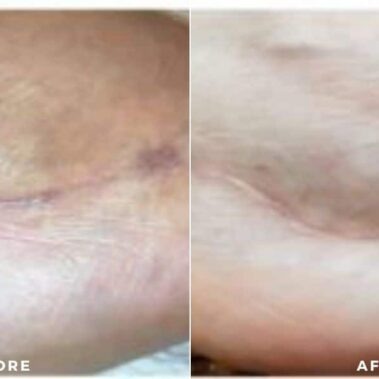 scar treatment before and after shiloh medical 5