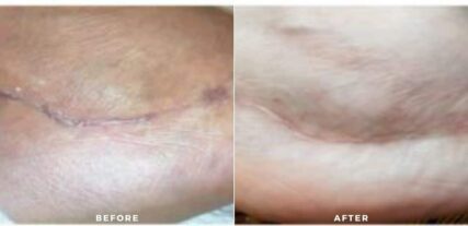 scar treatment before and after shiloh medical 5