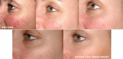 shilohmedical rosacea before and after series of treatment