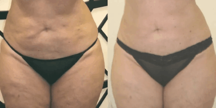 tlipo rescue six treatments