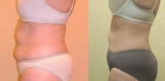 ultraslim before n after 6 sessions