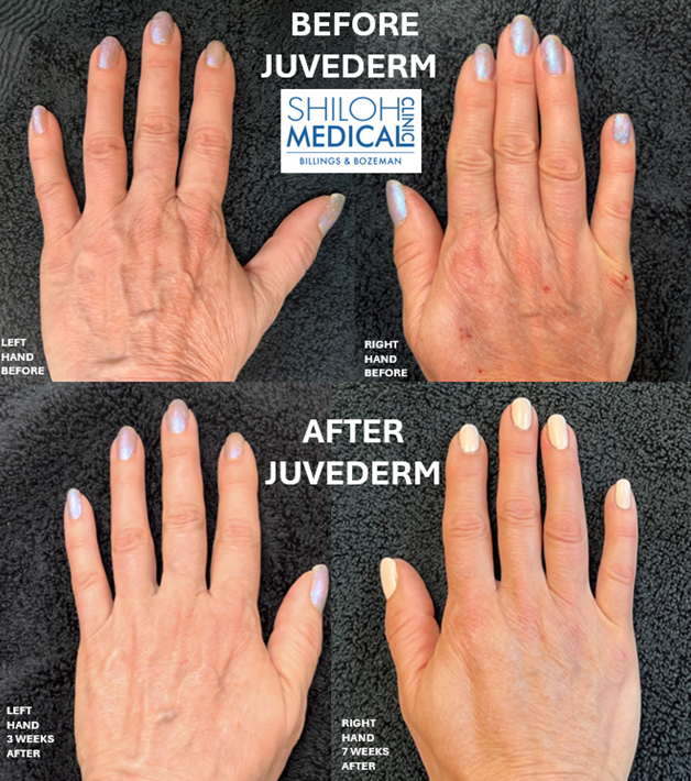 JUVEDERM HANDS both hands before and after photos with logo JUVEDERM HANDS both hands before and after photos with logo