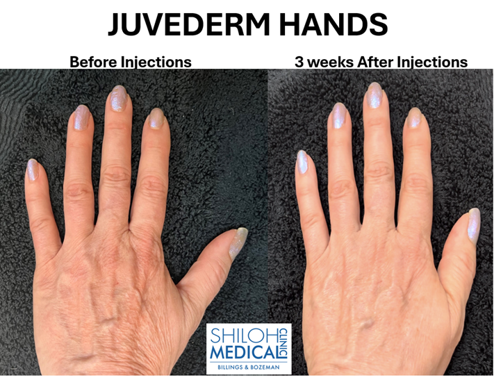 JUVEDERM HANDS left hand before and after photos with logo JUVEDERM HANDS left hand before and after photos with logo
