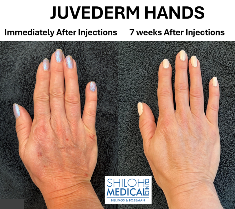 Juvederm Right Hand Before and After Juvederm Right Hand Before and After